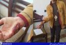 حمله سگ های ولگرد به یک نوجوان سرکانی/معظلی به نام تعدد سگ های ولگرد در یک شهر 
